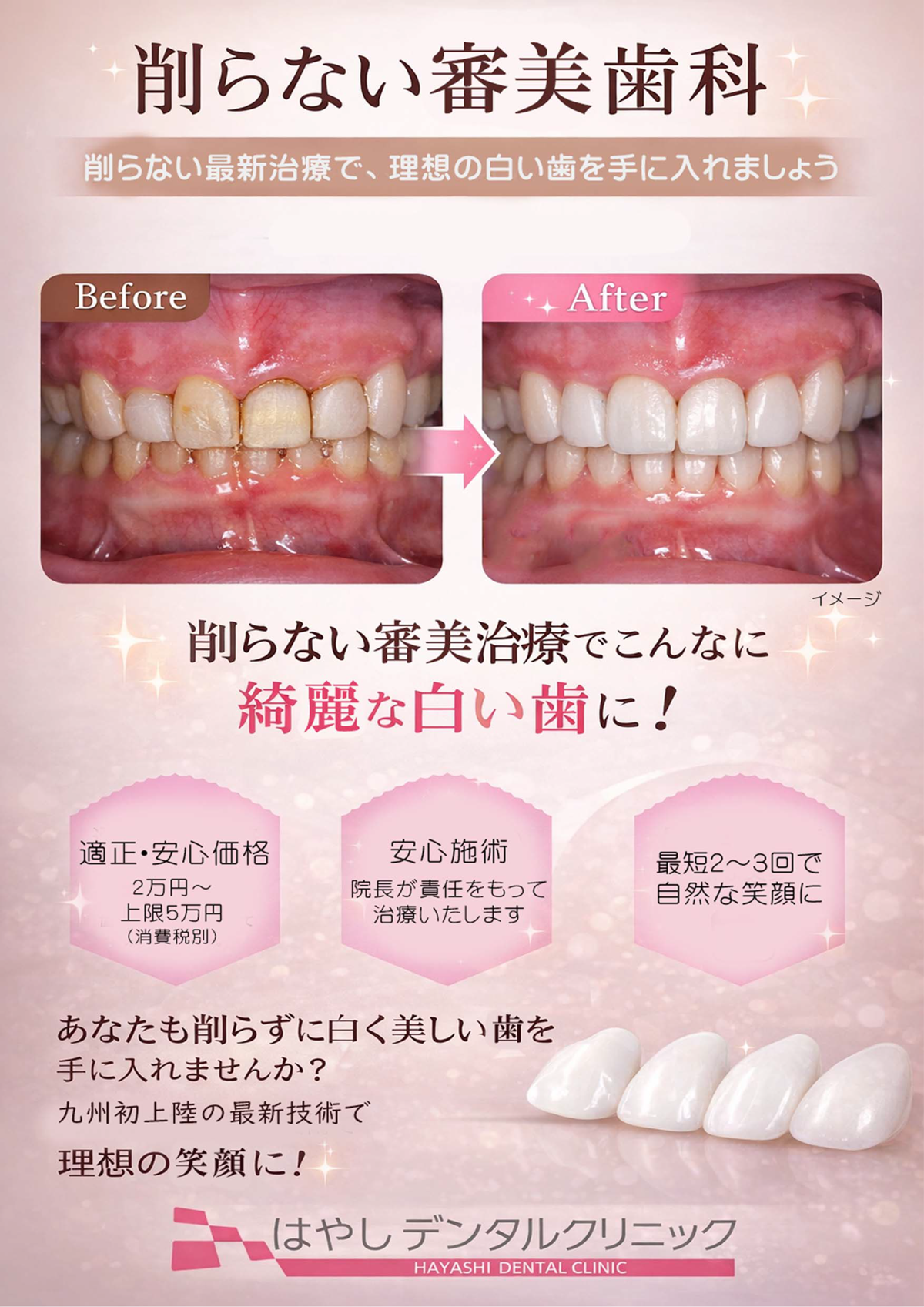 けずらない審美歯科,ラミネート
シェル,最短,2から3回